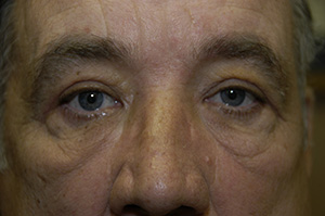 Blepharoplasty 5b